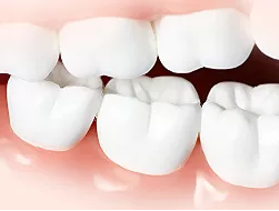 窩溝封閉可以預(yù)防齲齒嗎 孩子什么時(shí)候做窩溝封閉比較好