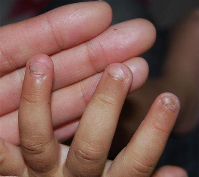 孩子指甲凹凸不平是缺乏營養(yǎng)嗎 怎么從寶寶指甲看身體健康狀況