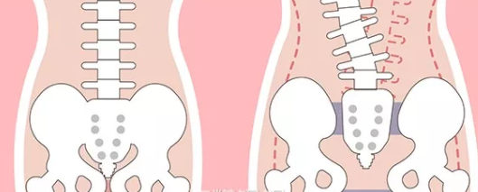 產后骨盆修復有必要做嗎 骨盆恢復需要去醫院嗎