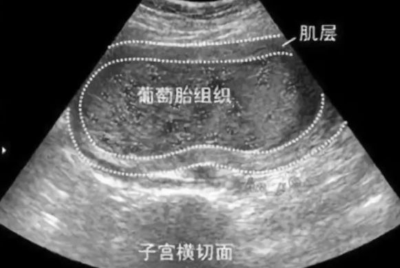 葡萄胎產(chǎn)生的原因是什么 葡萄胎的原因介紹