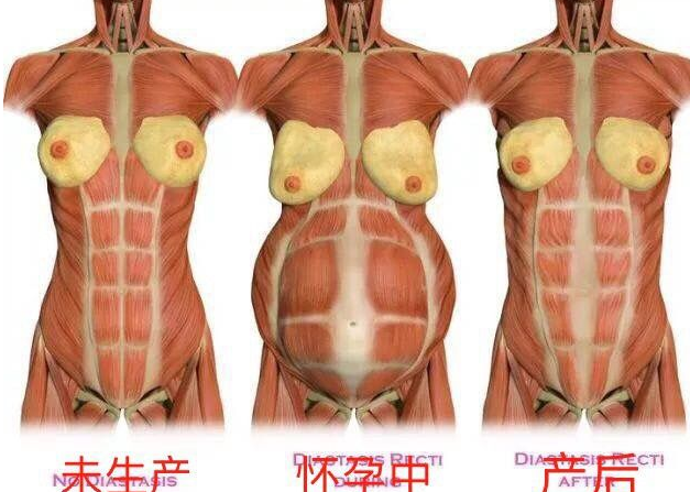 產后腹直肌分離自測圖解 腹直肌分離自測方法