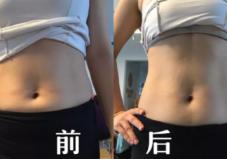 產后腹直肌分離有哪些危害 腹直肌分離的危害