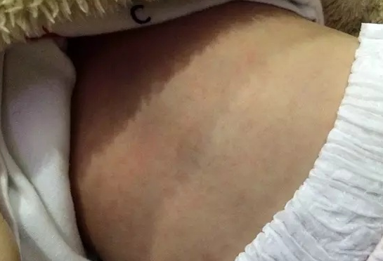 幼兒急疹有哪些癥狀 幼兒急疹的癥狀介紹