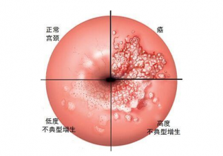宮頸癌早期癥狀一覽 宮頸癌早期有哪些癥狀