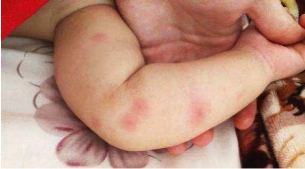 哪些會引起寶寶皮膚過敏 寶寶皮膚過敏護理方法