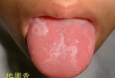 寶寶地圖舌是怎么回事 寶寶地圖舌的原因