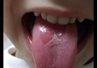 寶寶地圖舌怎么辦 寶寶地圖舌治療方法