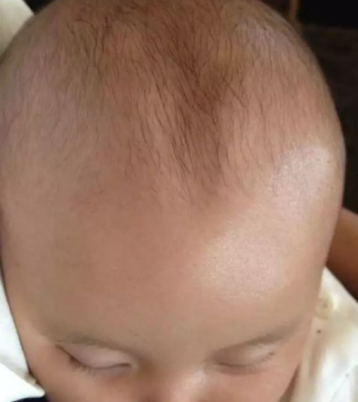 寶寶鹵門凸起怎么回事 寶寶鹵門凸起怎么辦 寶寶鹵門凸起怎么回事 寶寶鹵門凸起怎么辦