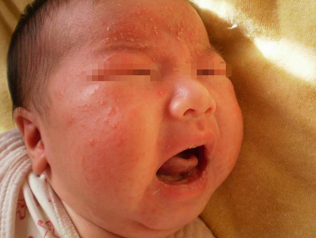 寶寶發(fā)生奶癬的原因 寶寶有奶癬怎么辦