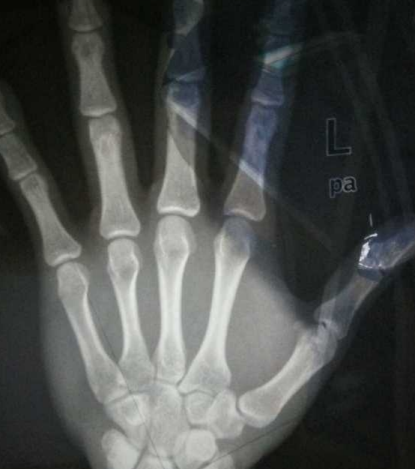 怎么預防骨齡提前 預防孩子骨齡提前方法