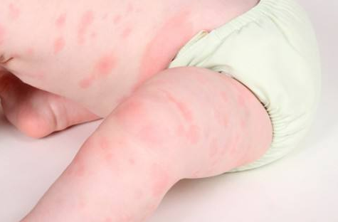 造成孩子過敏體質(zhì)的原因 過敏體質(zhì)是什么原因造成的