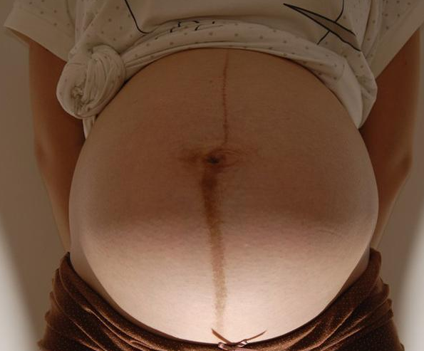 妊娠線變黑是懷孕了嗎 妊娠線越黑生男孩幾率越高嗎