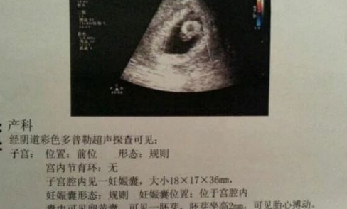 胎停育有哪些癥狀 怎么發現胎停育