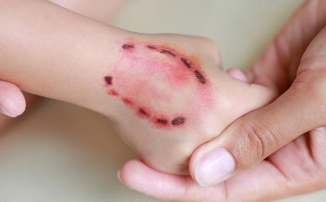 9歲男童被狗舔手后死亡是真的嗎 被狗舔也會(huì)得狂犬病嗎 9歲男童被狗舔手后死亡是真的嗎 被狗舔也會(huì)得狂犬病嗎