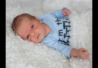 寶寶濕疹反復(fù)怎么辦 寶寶濕疹你知道該怎么護(hù)理嗎