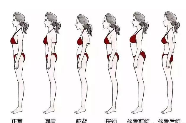 骨盆后傾的危害有哪些 骨盆后傾怎么矯正