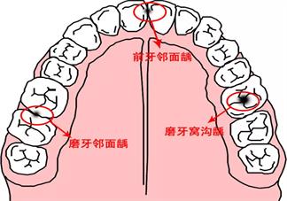 孩子有齲齒是什么原因?qū)е碌?孩子發(fā)齲病的主要原因是什么