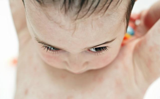 寶寶濕疹反復(fù)不好是什么原因 寶寶濕疹反復(fù)不好怎么辦