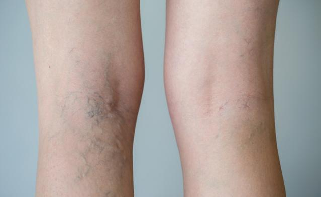 靜脈曲張的早期癥狀 孕媽出現(xiàn)靜脈曲張?jiān)趺崔k