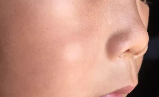 孩子臉上有白斑是積食還是蟲斑 孩子臉上有白斑原因有哪些 孩子臉上有白斑是積食還是蟲斑 孩子臉上有白斑原因有哪些