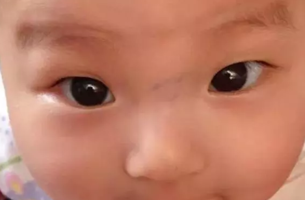 寶寶鼻梁上有青筋比較難養嗎 孩子鼻梁上方有青筋怎么回事 寶寶鼻梁上有青筋比較難養嗎 孩子鼻梁上方有青筋怎么回事