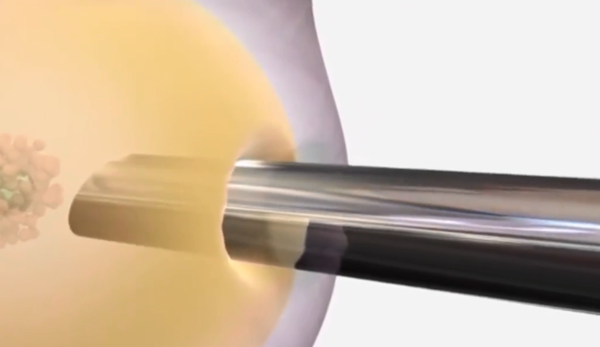 試管嬰兒對女性年齡有限制嗎 什么情況無法行試管嬰兒助孕