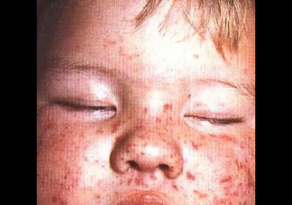 春季要預防孩“燒腦病” 孩子“燒腦病”是什么