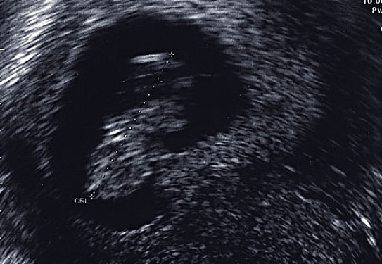 子宮內(nèi)膜增厚是什么原因 子宮內(nèi)膜增厚的原因