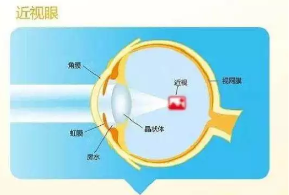 孩子真假性近視怎么分 怎么看孩子是真近視還是假性近視