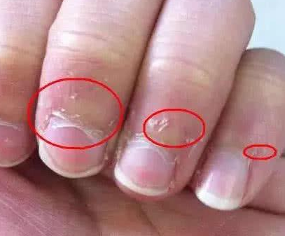 寶寶手上為何老長“這種東西”  孩子經常長倒刺該怎么辦