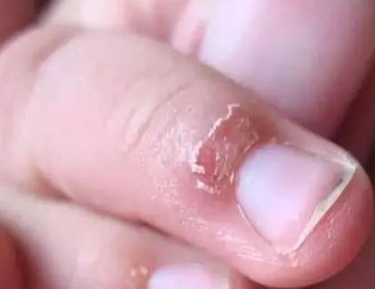 寶寶手上為何老長“這種東西”  孩子經常長倒刺該怎么辦