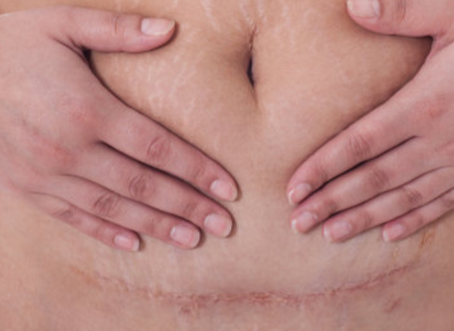 疤痕體質(zhì)的孕婦剖腹產(chǎn)是怎樣的體驗 疤痕體質(zhì)有多可怕