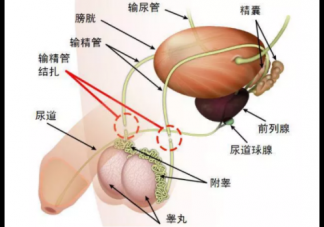 男性結扎有什么副作用 男性結扎影響性生活嗎