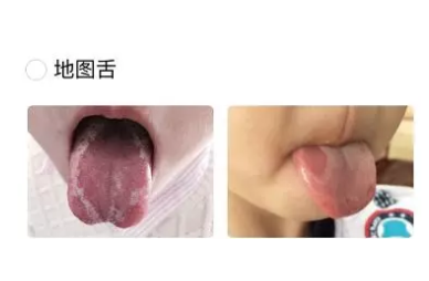 孩子地圖舌怎么調理 地圖舌的調理方法