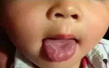 孩子地圖舌怎么調理 地圖舌的調理方法
