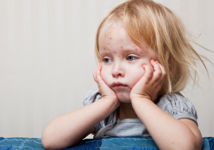 小兒蕁麻疹會引起發燒嗎 小兒蕁麻疹有什么癥狀