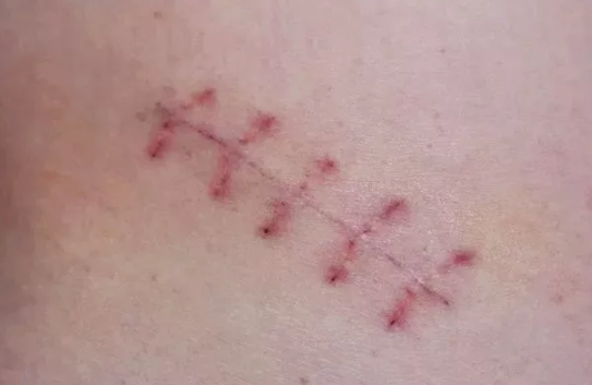 順產撕裂和側切有什么不同 順產撕裂和側切的區別