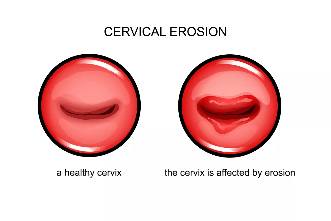 試管嬰兒移植后出血正常嗎 試管嬰兒移植后出血嚴重嗎