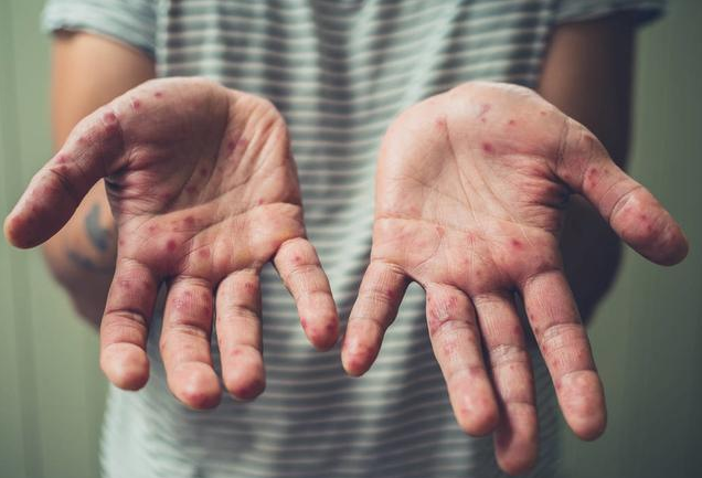 孩子手足口病什么時候要去醫院 感染手足口病如何護理