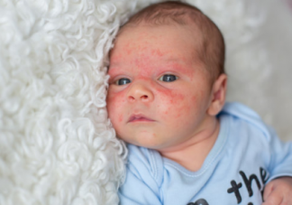 寶寶濕疹可以打疫苗嗎 哪些情況是寶寶不合適打疫苗