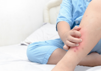 為何蚊蟲愛叮咬小孩子  孩子被蚊子咬了該怎么辦