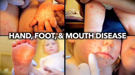 大人怎么預防寶寶手足口病 孩子手足口需要打疫苗嗎