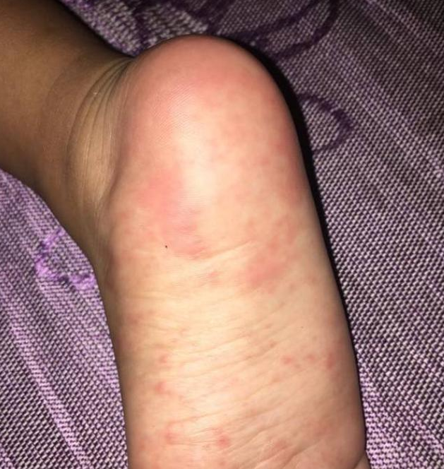 手足口病會(huì)引起哪些并發(fā)癥 如何照顧手足口病的患兒