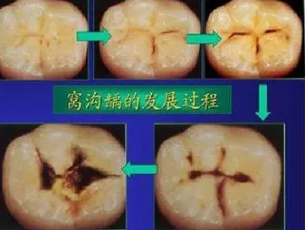后槽牙上的黑線是沒刷干凈嗎 窩齲該怎么預防