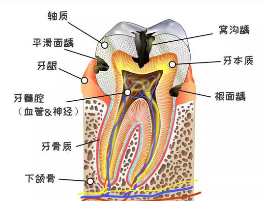 后槽牙上的黑線是沒刷干凈嗎 窩齲該怎么預防