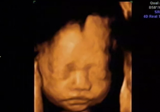 胎兒頭大是什么原因 胎兒頭大的原因