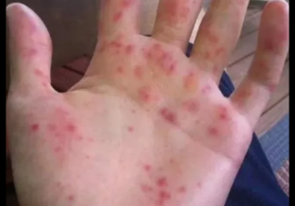 孩子手足口病會死人嗎 重度手足口病有什么特點