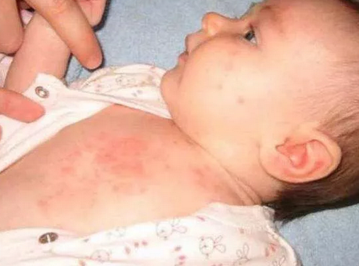 天氣炎熱如何預防寶寶長痱子 寶寶長了痱子怎么辦