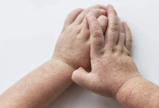 小兒麻疹如何護理 小兒麻疹的護理方法 小兒麻疹如何護理 小兒麻疹的護理方法