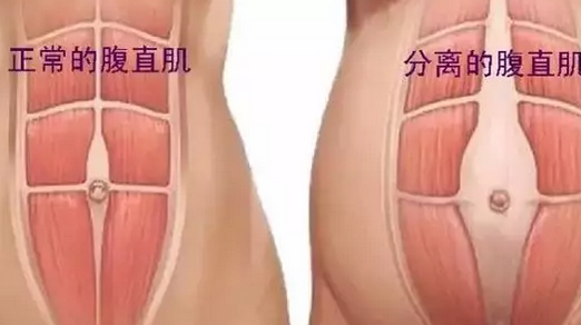 為什么產(chǎn)后肚子還是收不回來 什么是產(chǎn)后腹直肌分離